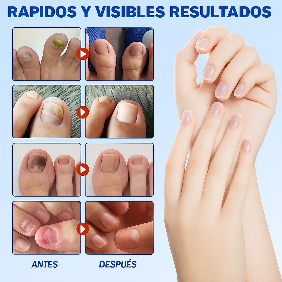 Nuevo SET de 30 unidades de Parche Milagroso para Uñas Saludables
