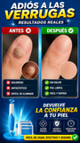 Nuevo Anillas Eliminadoras de Verrugas Rápidas