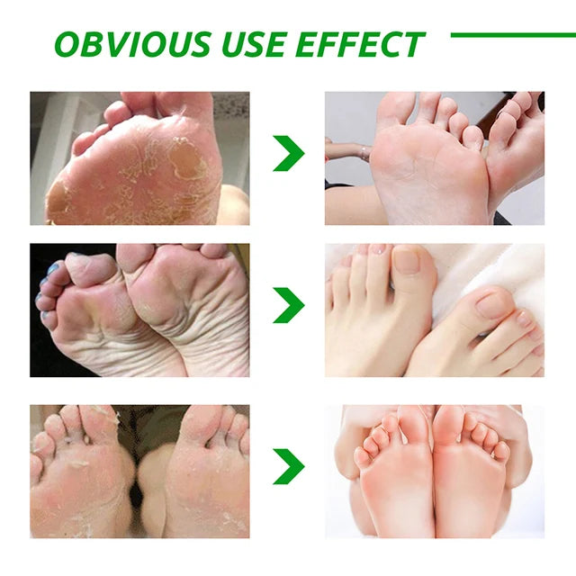 Nueva Máscara Exfoliante para pies