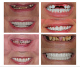 Nueva Dentadura de silicona Perfecta en Casa
