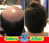 Nuevo Minoxidin y biotina suero para la caida del cabello