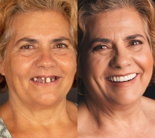 Nueva Dentadura de silicona Perfecta en Casa