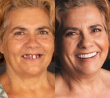 Nueva Dentadura de silicona Perfecta en Casa