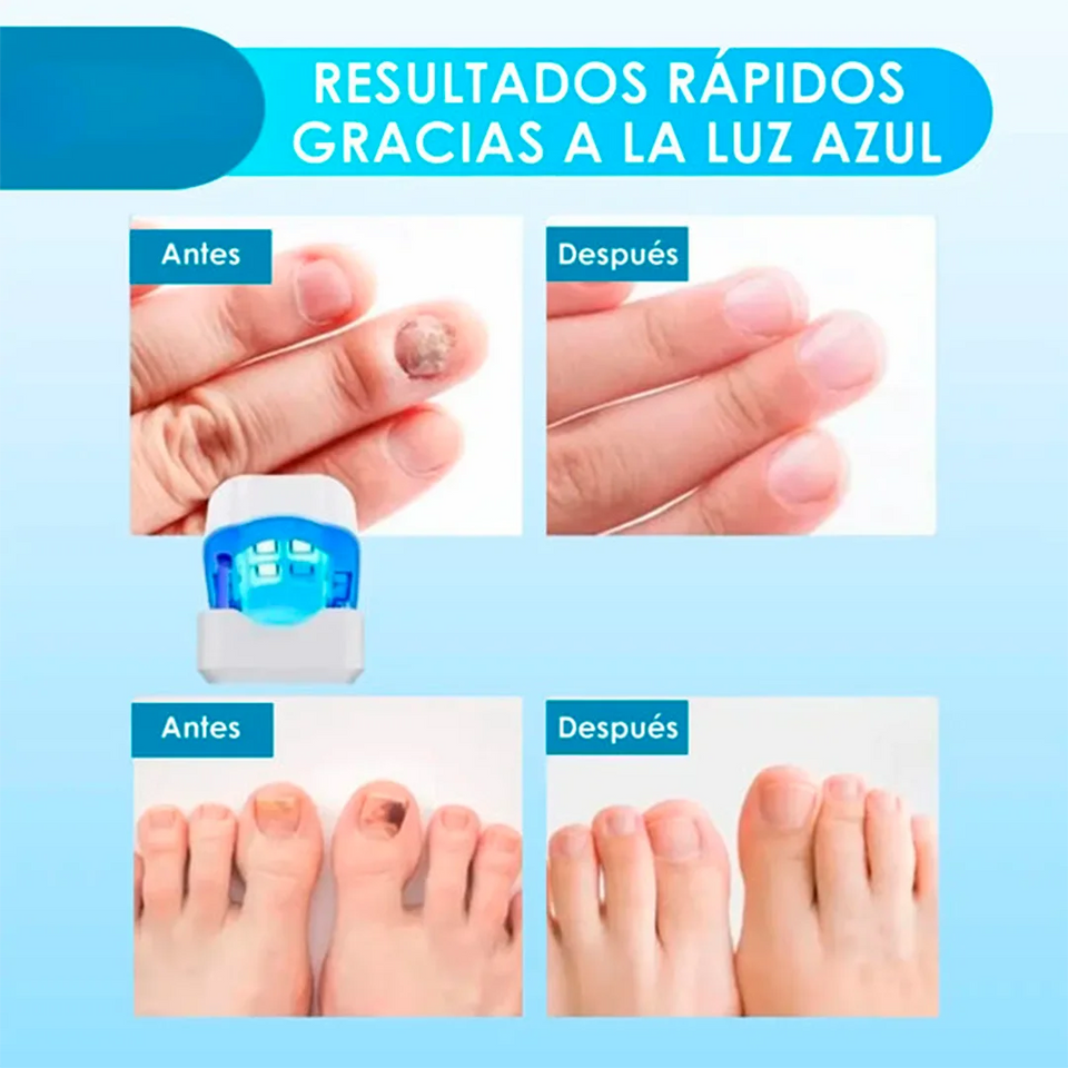 Nueva CuraLáser: Uñas Fuertes y Saludables