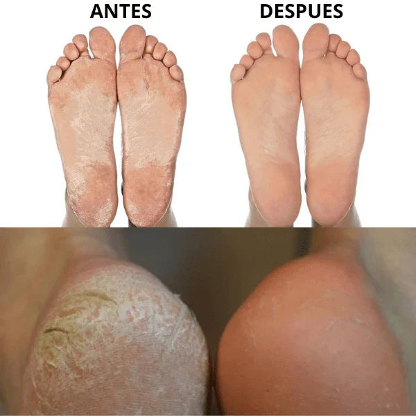 Nuevo removedor de callos para Pies